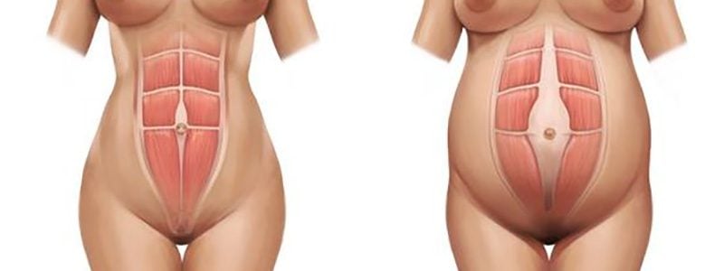 diastase abdominal