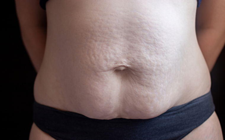 diastase abdominal
